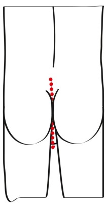 Эрекционное кольцо с цепочкой для стимуляции ягодиц